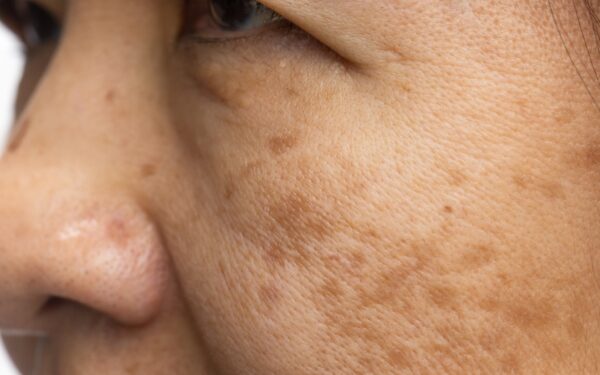 Melanose solar: indícios acima dos 50 anos