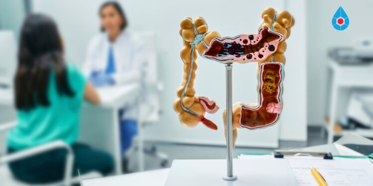 Teste revolucionário para o câncer de intestino