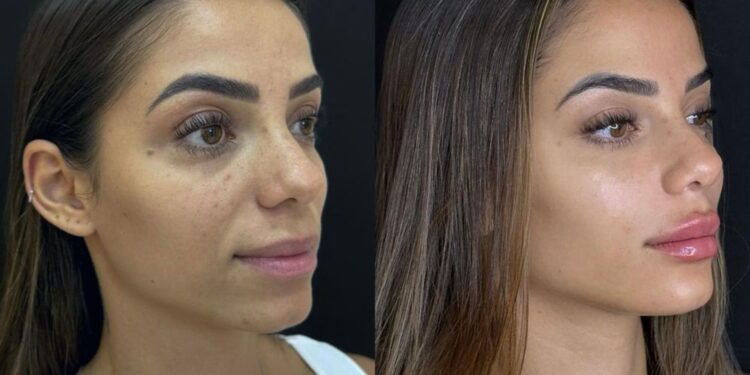 Key Alves faz harmonização facial e surpreende