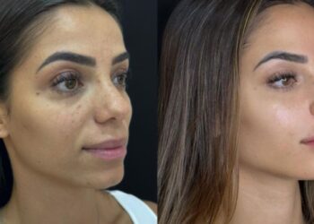 Key Alves faz harmonização facial e surpreende