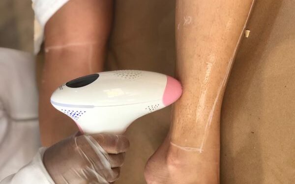 Mitos e verdades sobre depilação a laser