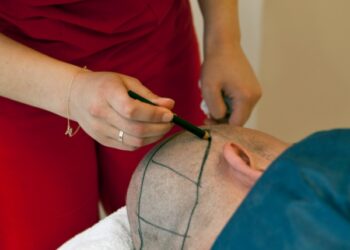 Os diferentes tipos de transplante capilar