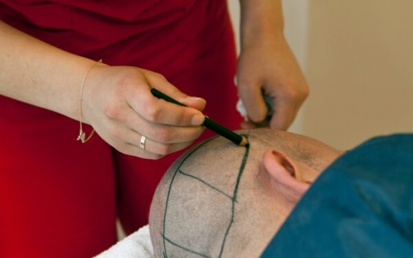 Os diferentes tipos de transplante capilar