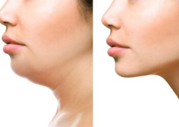 O poder real da lipo a laser