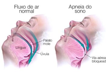 Apneia do sono: ameaça silenciosa à saúde