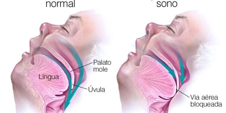 Apneia do sono: ameaça silenciosa à saúde