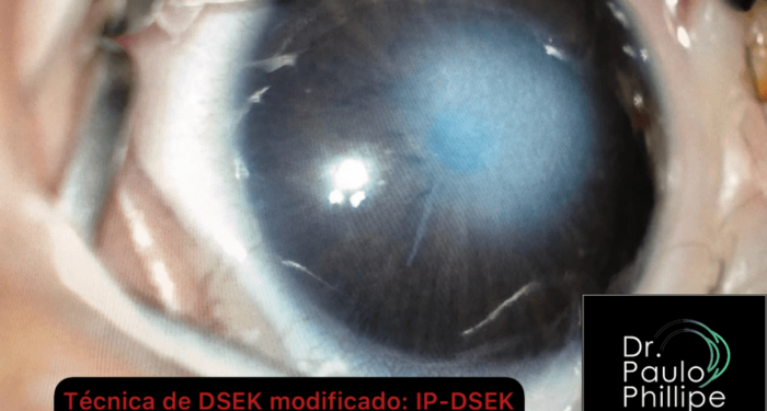 Nova técnica devolve visão a recém-nascida