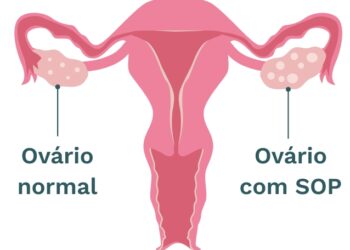 Síndrome de Ovários Policísticos