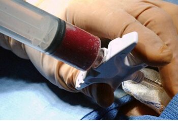 Quem pode doar Medula Óssea?