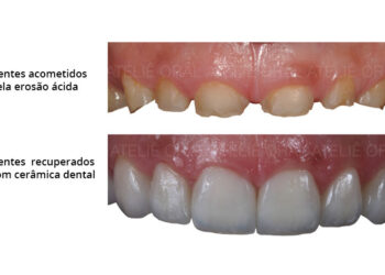 Erosão Dentária: o mal do século para a saúde bucal