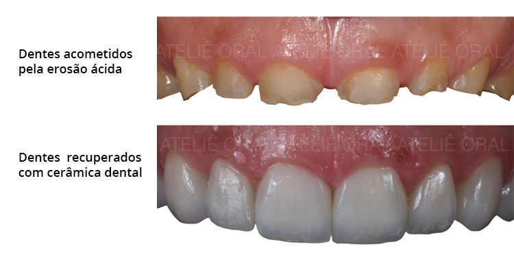 Erosão Dentária: o mal do século para a saúde bucal